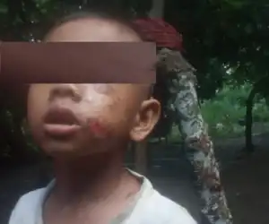 Sadis! Anak Tunawicara di Aceh Utara &ldquo;Dibakar&rdquo; Ayah Kandung